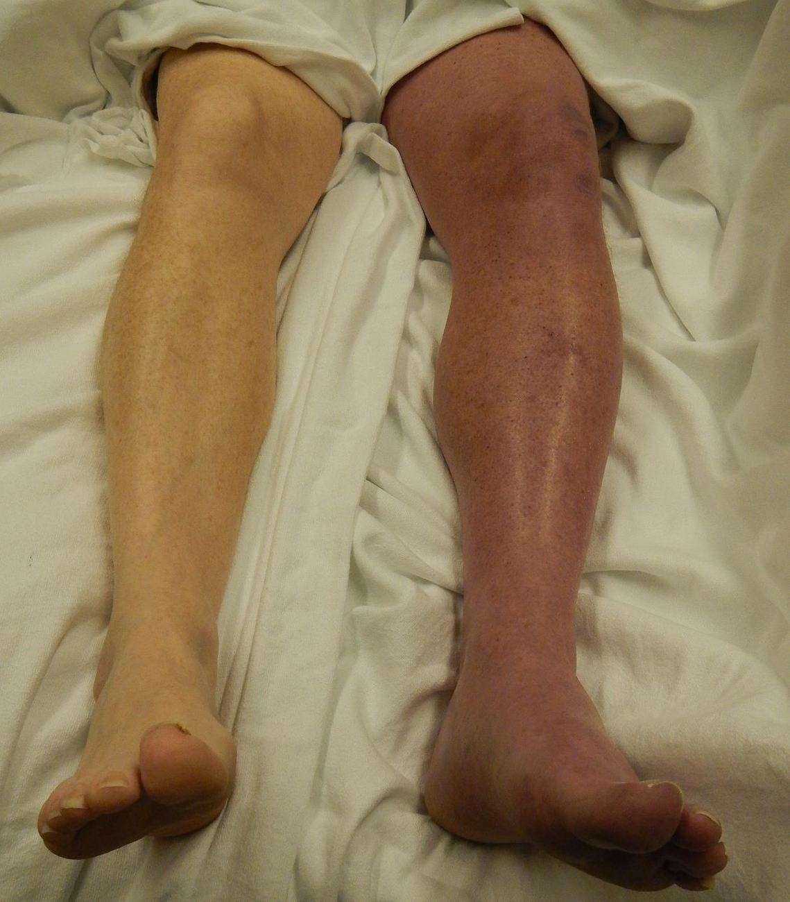 Photograph of an enlarged cyanotic painful left lower limb.