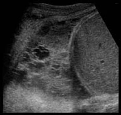 Lung ultrasound showing a complex loculated pleural effusion with adjacent consolidation.