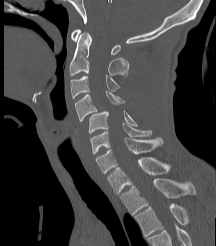 Sagittal CT cervical spine showing C4 on C5 anterolisthesis and canal narrowing.