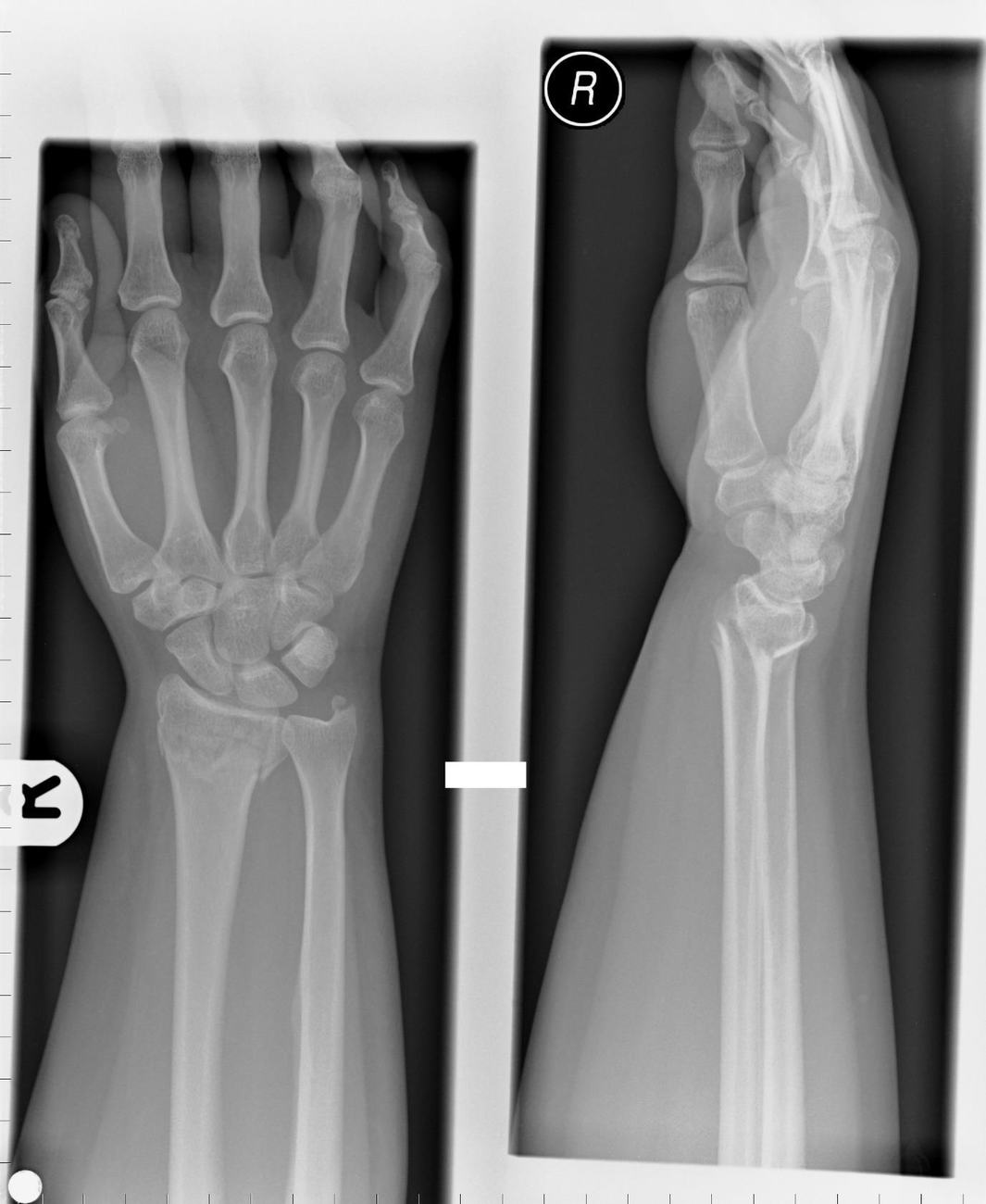 AP and lateral right wrist X-rays showing distal radius fracture with dorsal angulation.