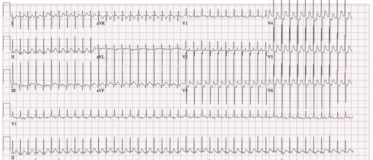Twelve-lead ECG showing a regular narrow-complex tachycardia.