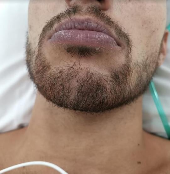 Clinical image showing cyanosed lips in a patient with suspected methaemoglobinaemia.