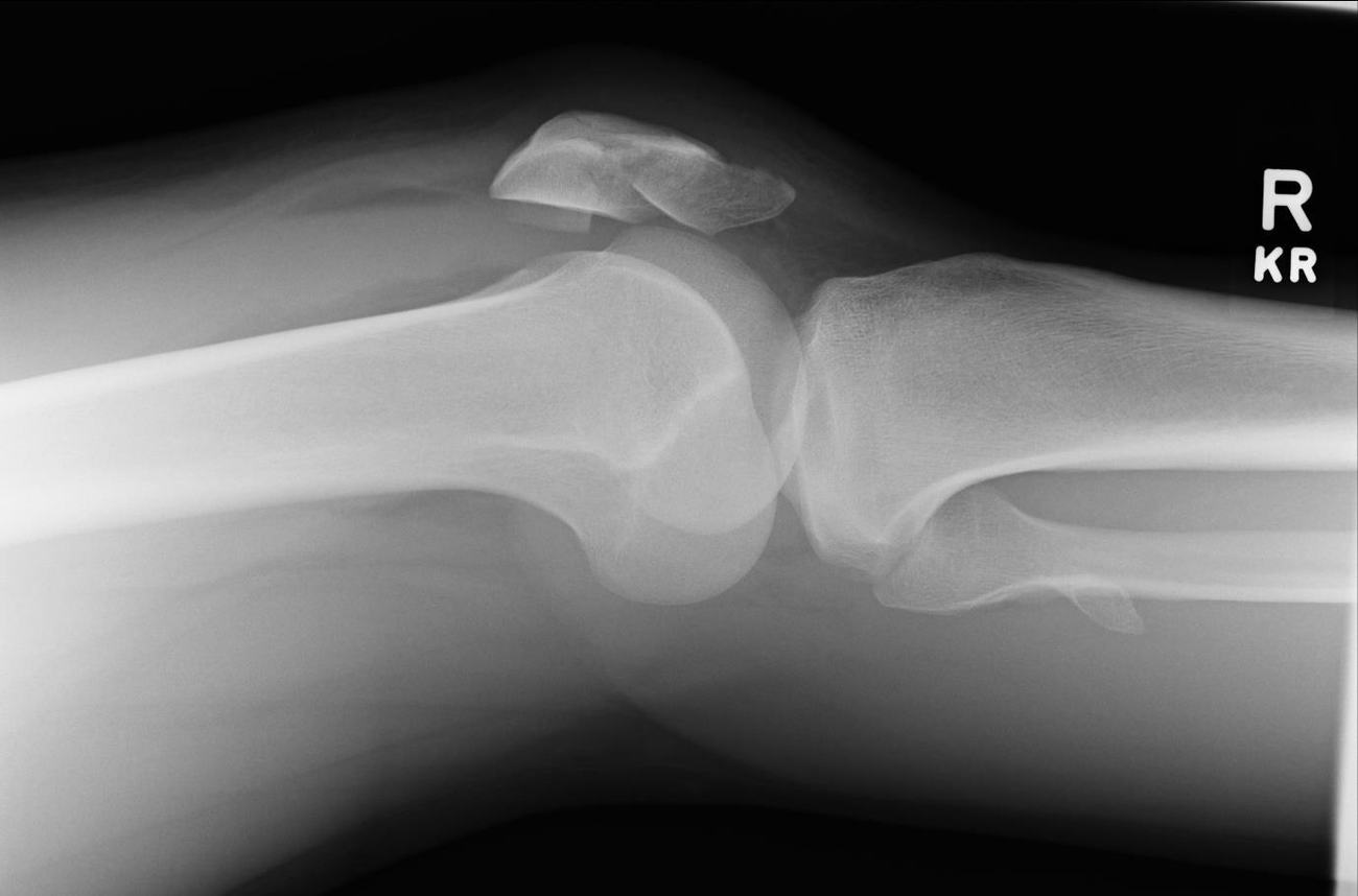 Lateral knee X-ray showing a displaced comminuted patella fracture.
