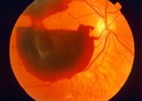 Fundoscopy image showing dense vitreous haemorrhage.