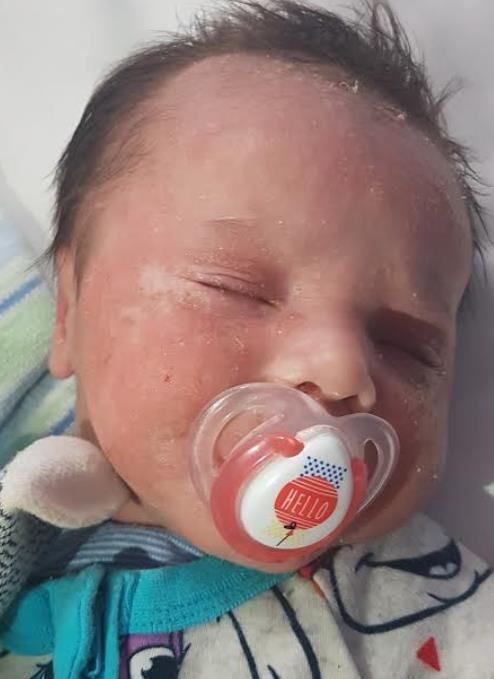 Infant facial erythema and crusting.