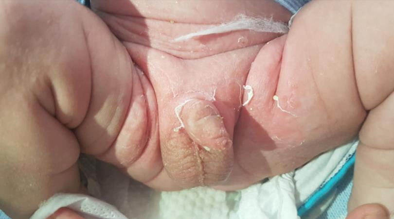Infant rash with blistering and desquamation in the groin.