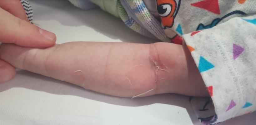 Infant limb rash with erythema and peeling.