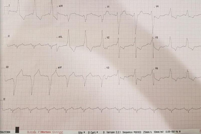 12-lead ECG showing LBBB with concordant ST depression in anterior leads.