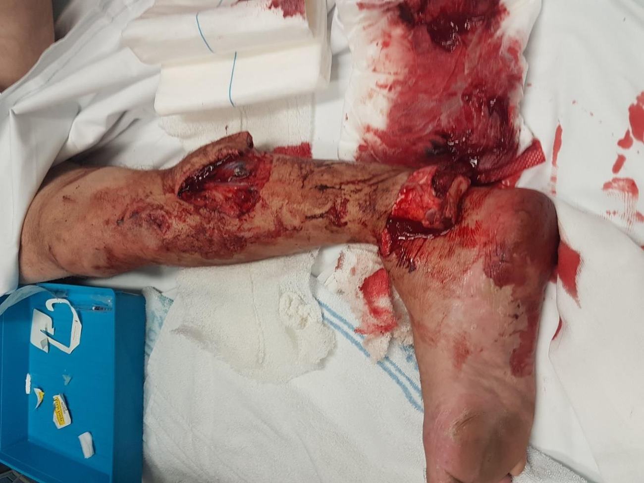 Clinical photograph of an open ankle fracture-dislocation with calf wound.