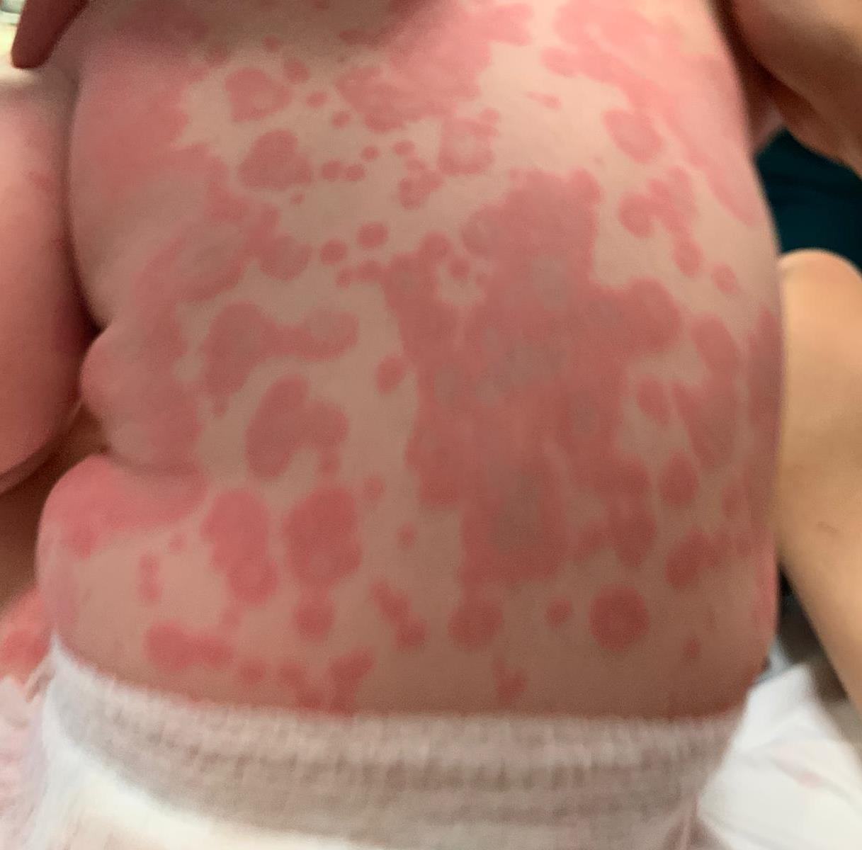 Toddler rash with targetoid erythematous plaques.