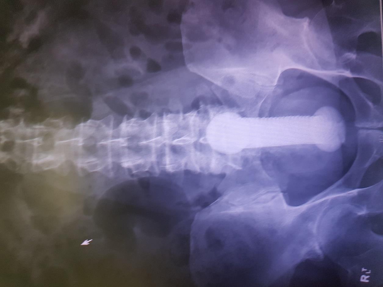 Abdominal X-ray showing a rectal foreign body.
