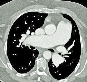 Axial CTPA image showing enlarged pulmonary arteries.