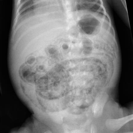 Neonatal abdominal X-ray showing pneumatosis intestinalis.