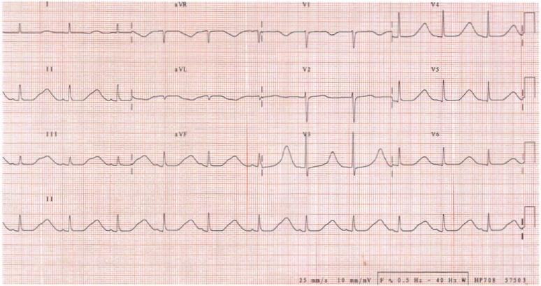 12-lead ECG showing prolonged QT interval.