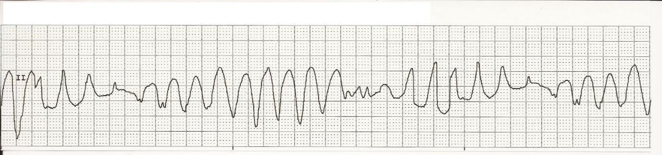 Ambulance rhythm strip showing torsades de pointes.