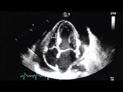Bedside echocardiography apical four-chamber image showing pericardial effusion.
