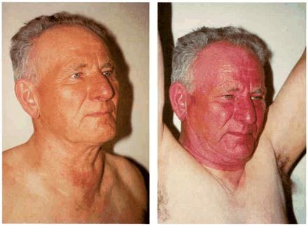 Clinical photograph showing facial plethora with arms raised consistent with Pemberton sign.