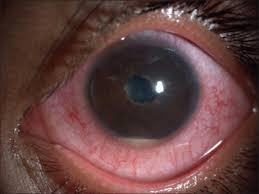 Close-up eye photograph showing conjunctival injection and hypopyon.