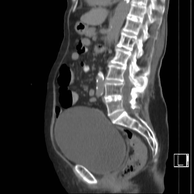 Sagittal CT image showing a markedly distended bladder.