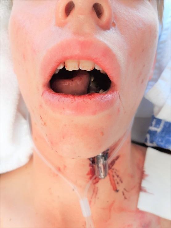 Clinical photograph of penetrating submandibular/floor-of-mouth foreign body.