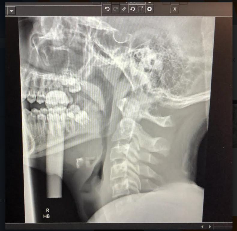 Lateral neck x-ray showing the penetrating foreign body.