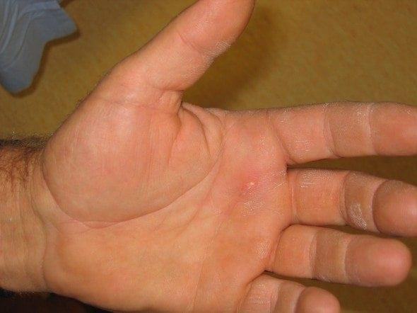 Clinical photograph of a high-pressure injection injury to the hand.