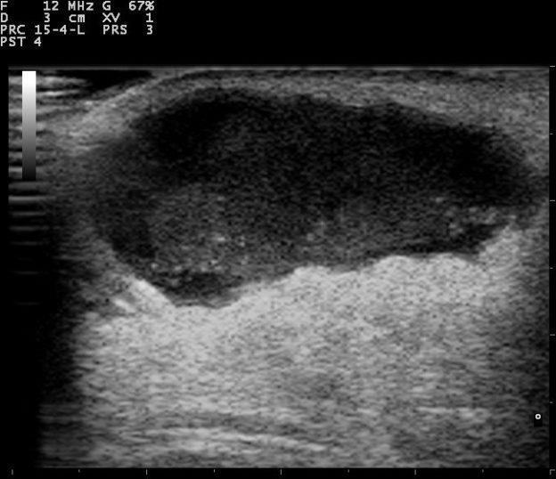 Breast ultrasound showing a hypoechoic collection consistent with abscess.
