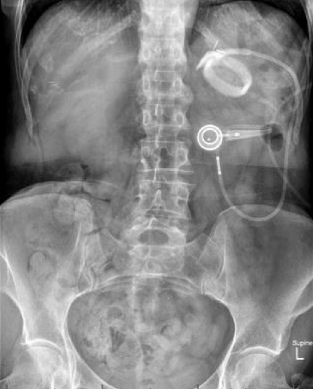 Abdominal X-ray showing a laparoscopic gastric band.