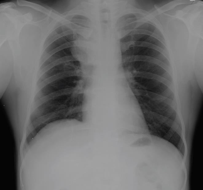 Chest X-ray with right mediastinal opacity and elevated right hemidiaphragm.