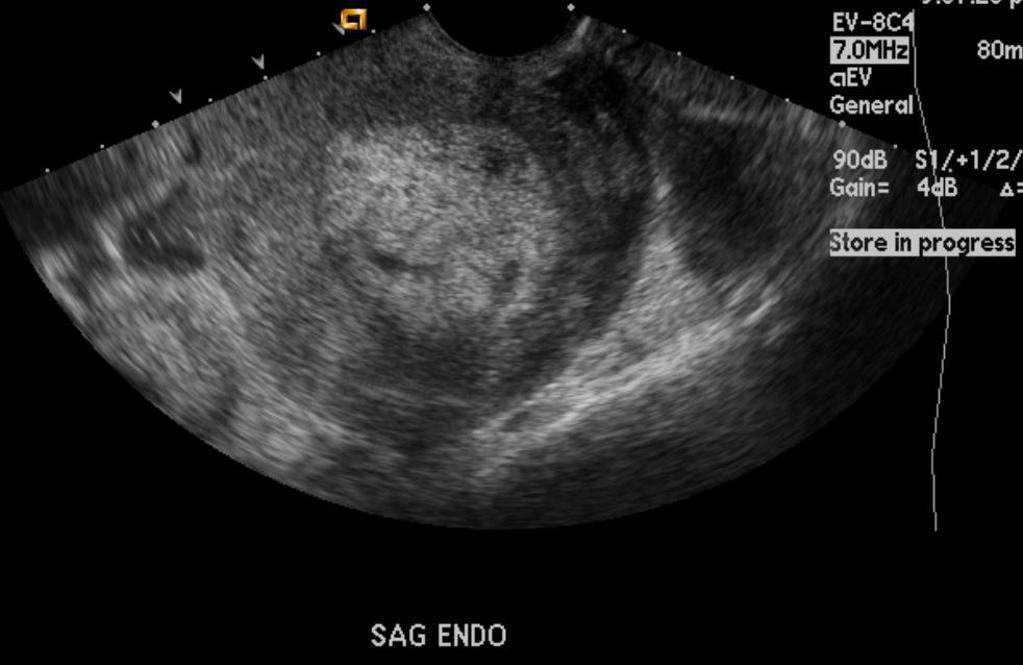 Transvaginal ultrasound showing heterogeneous material in a distended endometrial cavity.