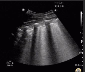 Lung ultrasound image showing widespread B-lines.