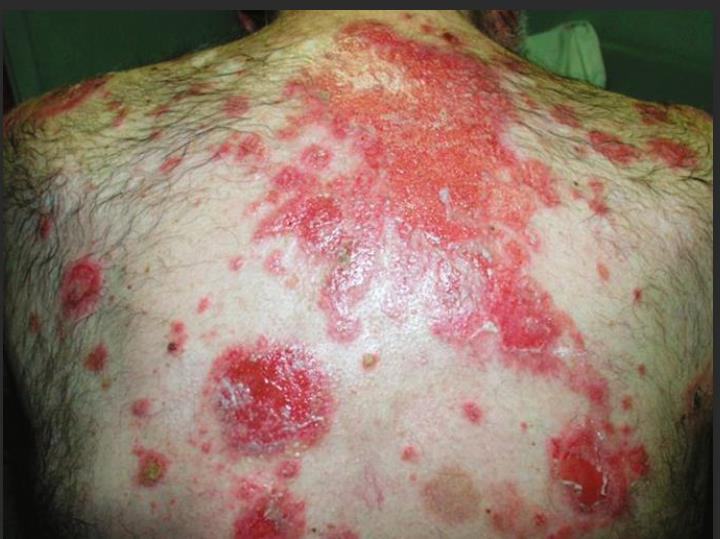 Clinical photograph of widespread erythematous blistering rash on the back.