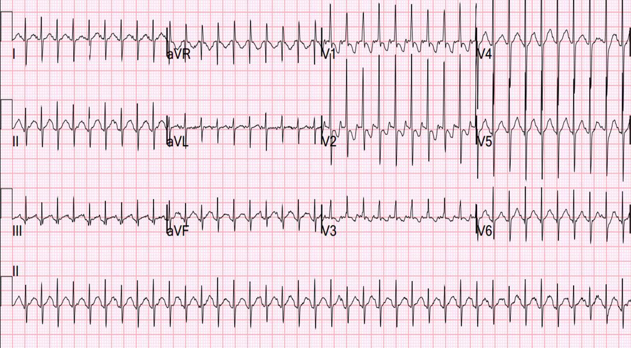 ECG showing regular narrow-complex tachycardia.