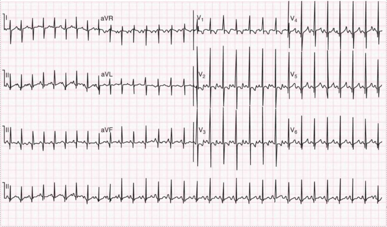 Neonatal ECG showing sinus tachycardia and normal neonatal right-sided dominance.
