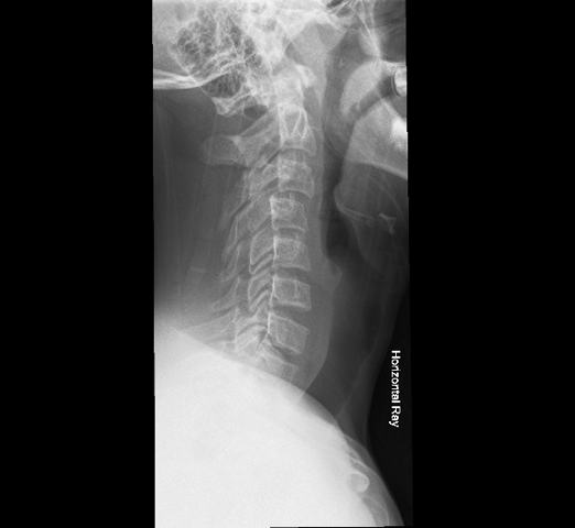 Lateral cervical-spine x-ray in a child with traumatic neck pain.