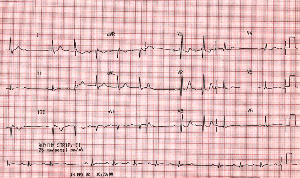 ECG showing Mobitz type II second-degree AV block.