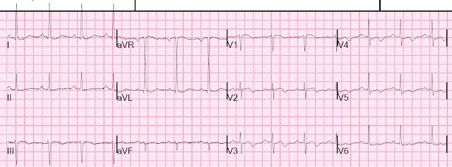Pain-free ECG with anterior biphasic T-wave changes consistent with Wellens syndrome.