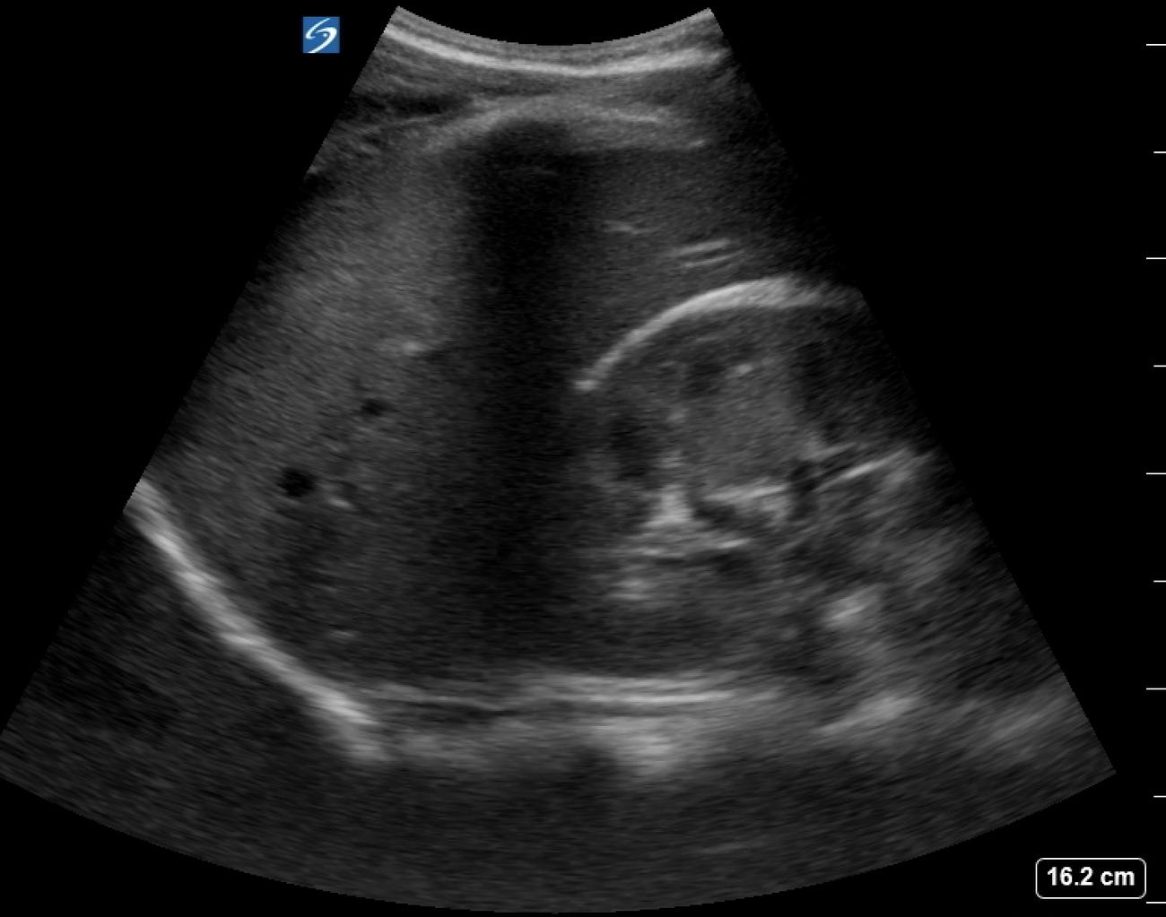 FAST right upper quadrant image.