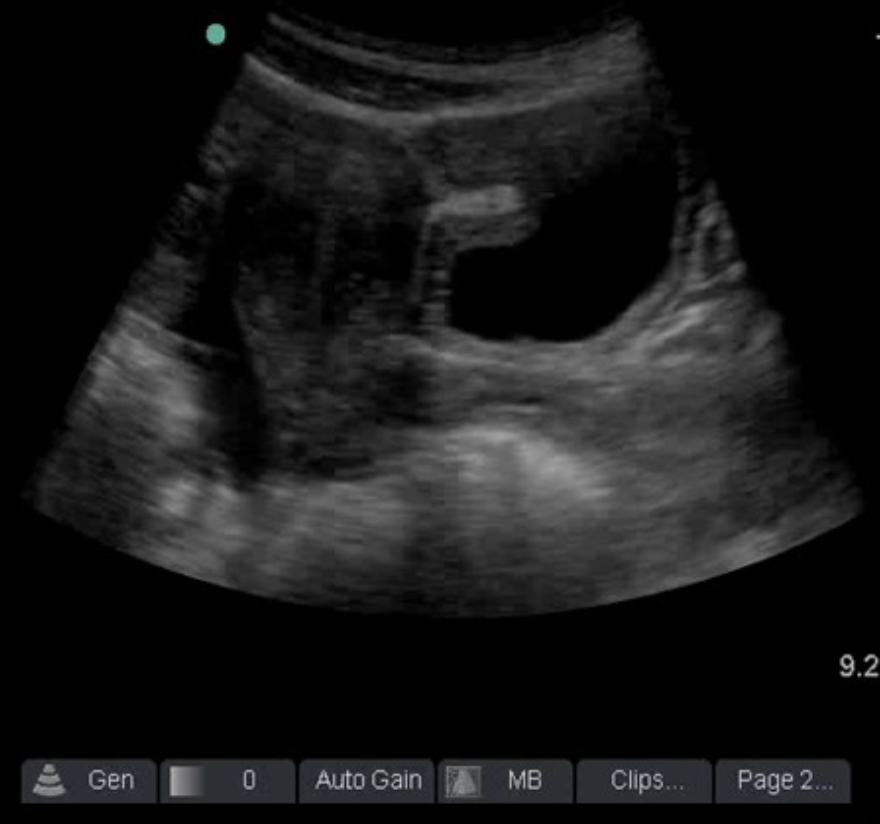 FAST pelvic longitudinal image.
