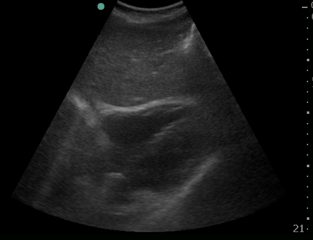 FAST subxiphoid cardiac view.