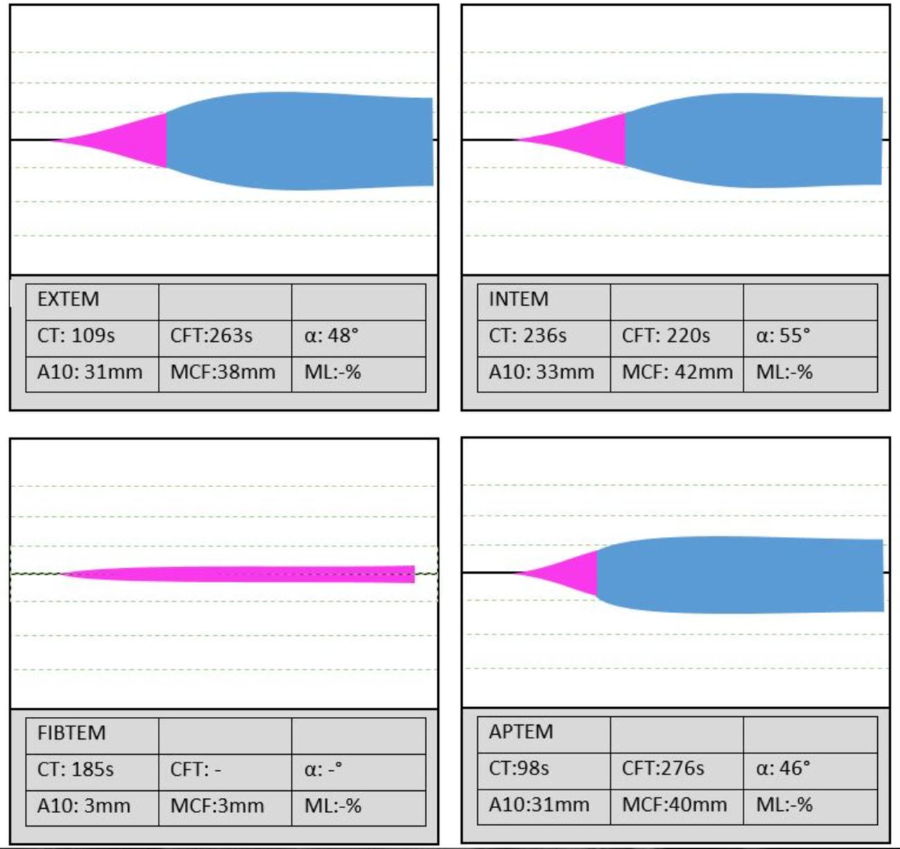 ROTEM result showing severe hypofibrinogenaemia.