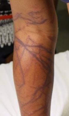 Linear red-purple welts on a child's leg after marine exposure.