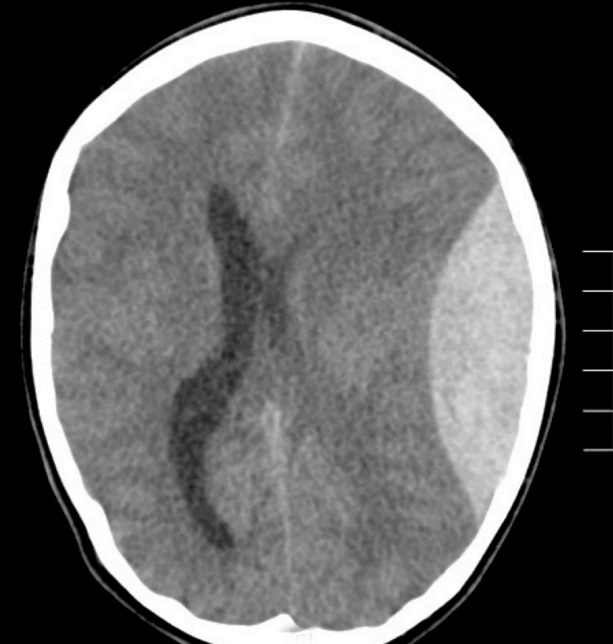 CT brain showing a large left extradural haemorrhage with mass effect.