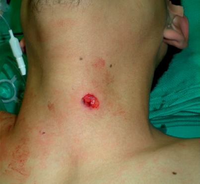 Penetrating anterior neck wound from a kitchen knife.