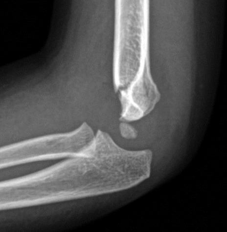 Lateral elbow x-ray showing paediatric supracondylar fracture.