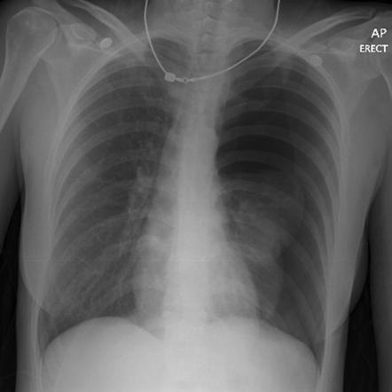 Chest x-ray showing left tension pneumothorax after NIV.