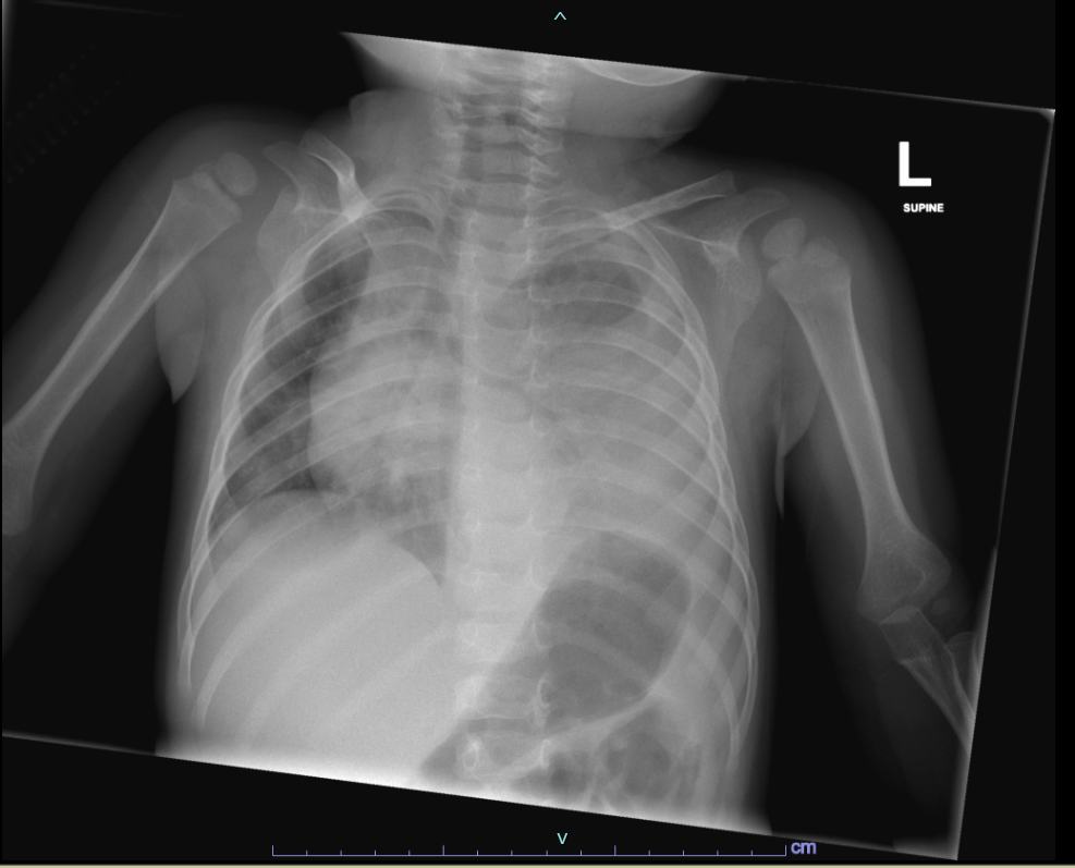 Paediatric chest x-ray showing left-sided pneumonia with a large effusion.