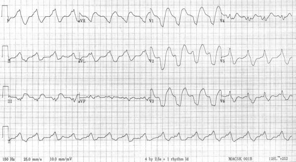 ECG showing wide-complex rhythm consistent with sodium-channel blockade.