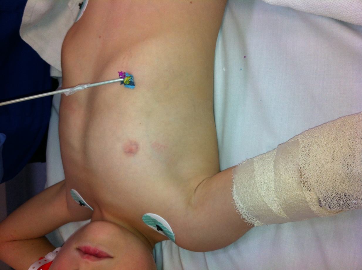 Clinical photograph of a paediatric penetrating right anterior chest injury.