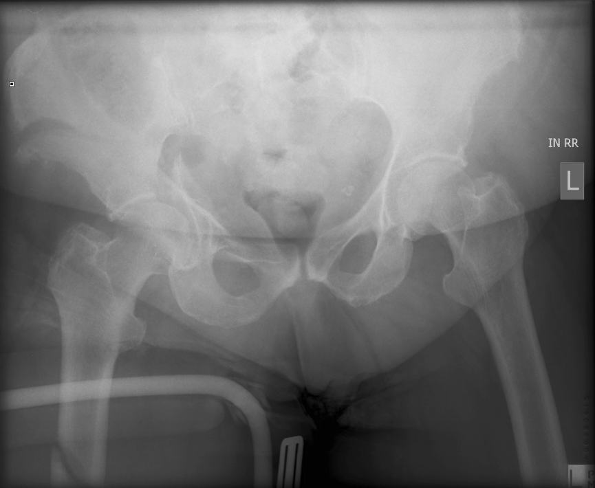 Portable pelvic x-ray showing unstable pelvic fractures after high-speed trauma.